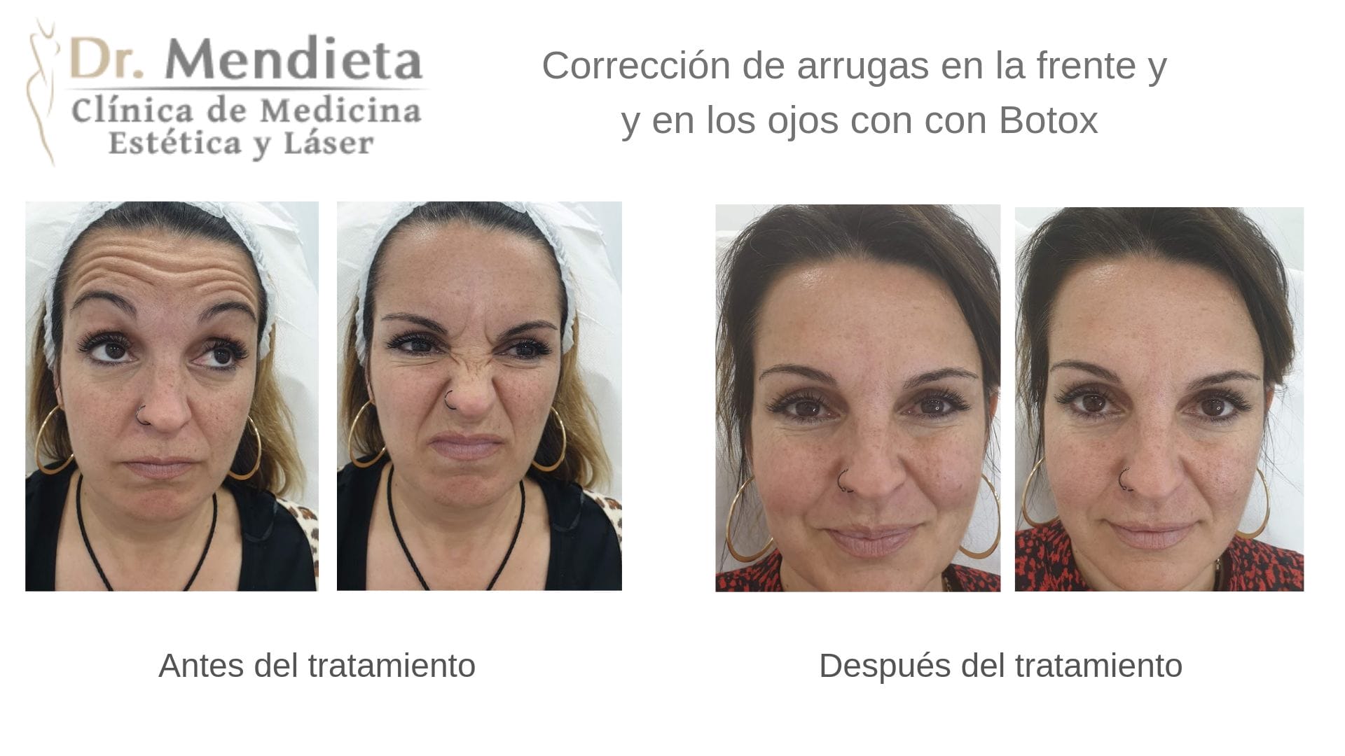 Rejuvenecimiento facial con Bótox