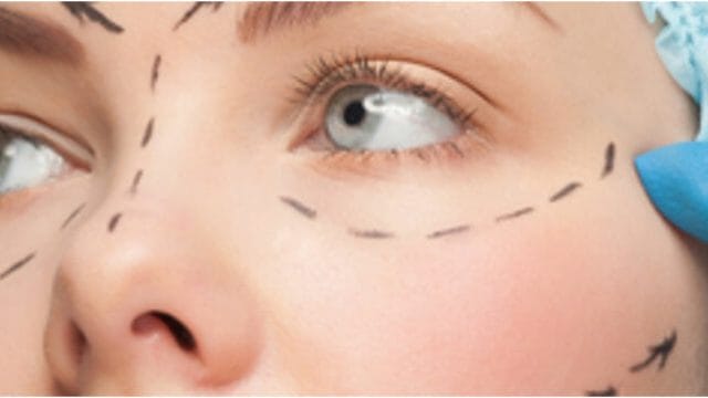 Blefaroplastia sin cirugía